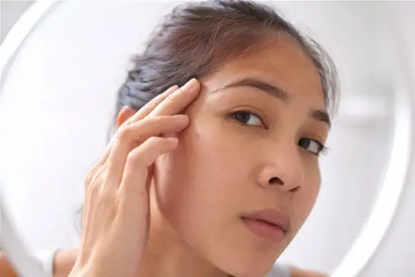 Acné adulte et traitement à l'acide azélaïque Skinoren Finacea