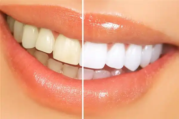 Bicarbonate de soude et citron pour blanchir les dents - recette naturelle