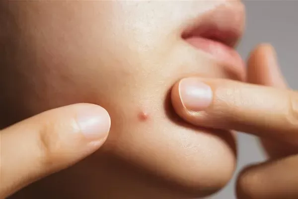 Soins naturels pour traiter l'acné efficacement
