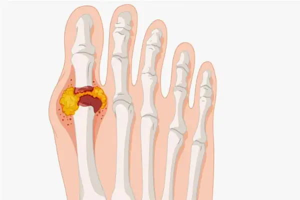 Aliments à éviter et à privilégier pour un régime contre la goutte et l'acide urique