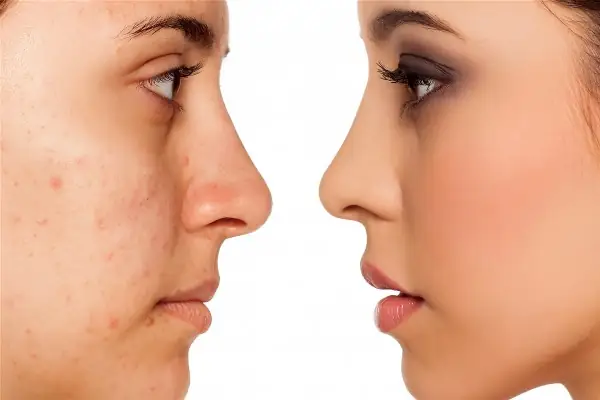 Huile d'onagre et ses bienfaits contre l'acné inflammatoire