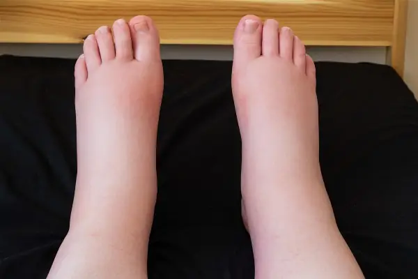 Rétention d'eau: causes et solutions naturelles pour les jambes gonflées