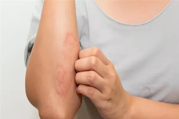 Remèdes naturels contre l'eczéma : huile de coco, avoine, miel et plantes médicinales