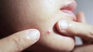 conseils pour soigner l’acné naturellement