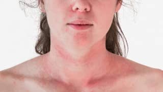Réactions Allergiques Mythe § Réalité - Naturalexis