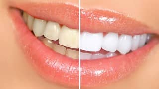 blanchir les dents bicarbonate et citron