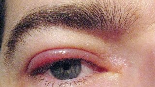 Eye Swelling Causes and Treatment - Puffy Eyes Remedies - Naturalexis