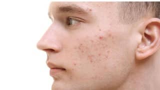 Pantothenic Acid - Positive Effect Of Vitamin B5 Against Acne