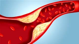 Symptômes du Cholestérol Élevé