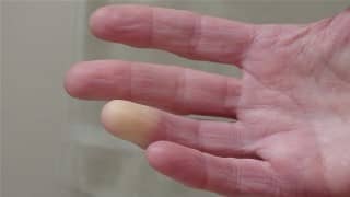 syndrome de raynaud causes